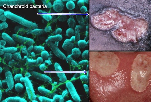 sipilis apakah menular