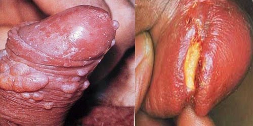 ciri2 sipilis mau sembuh